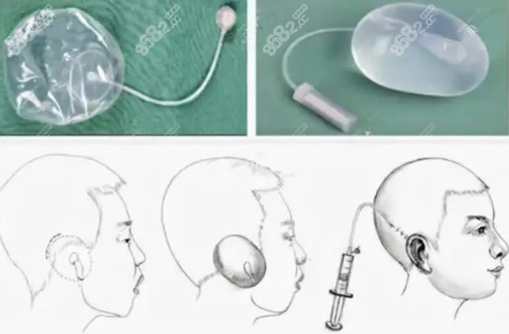 小耳再造全包法手术