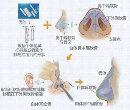 金成南医生修复软骨隆鼻手术