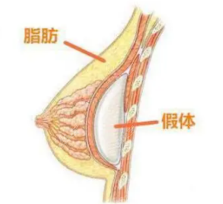 假体隆胸手术