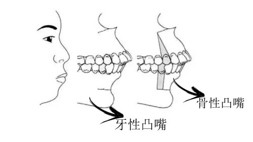 牙性前突的前牙倾斜程度大