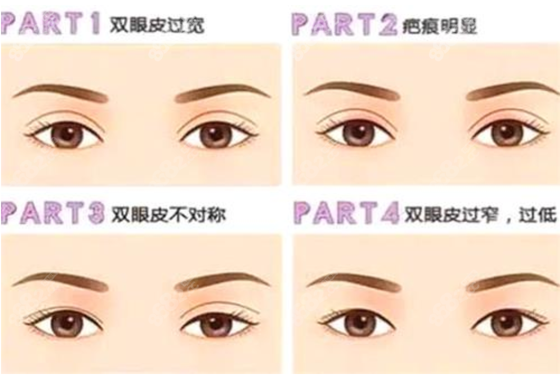韩国眼修复类型多8682.cc