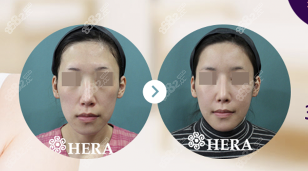 韩国赫拉整形鼻整形手术8682.cc