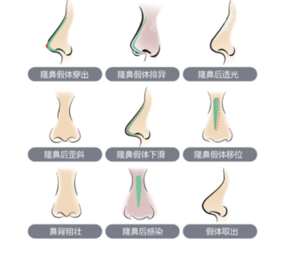 韩国431医院鼻修复怎么样