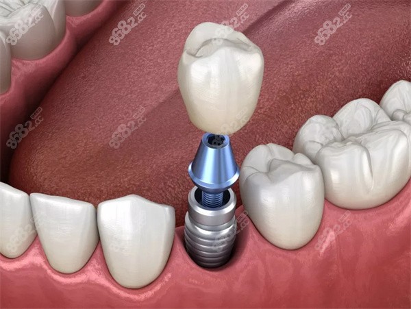 有种植牙可以做牙齿矫正吗？