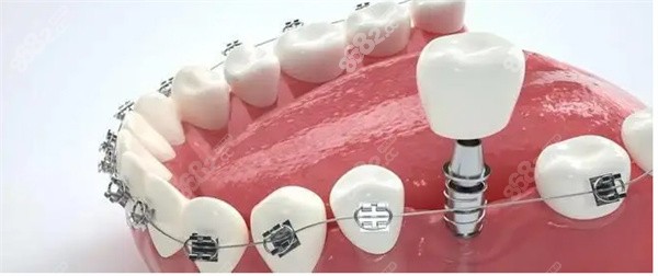 解答种植牙后可以做牙齿矫正吗