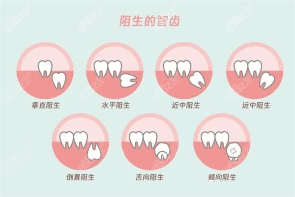 昆山拔智齿多少钱一颗