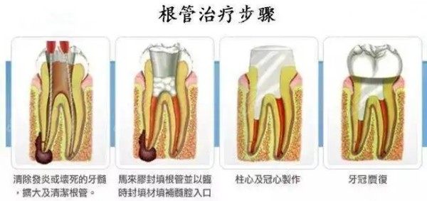 根管治疗流程图