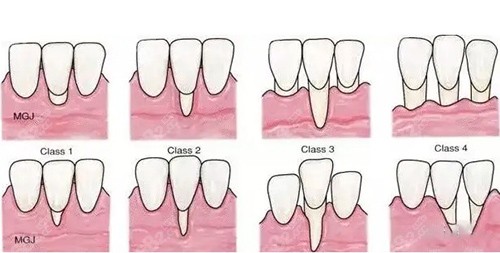 牙龈萎缩各个阶段图片大全，三十岁牙龈萎缩还能恢复吗