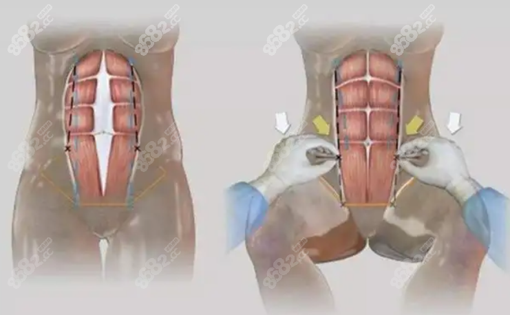 腹壁成型手术全过程