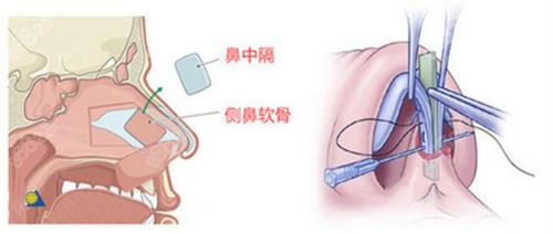 韩国原辰鼻修复技术图