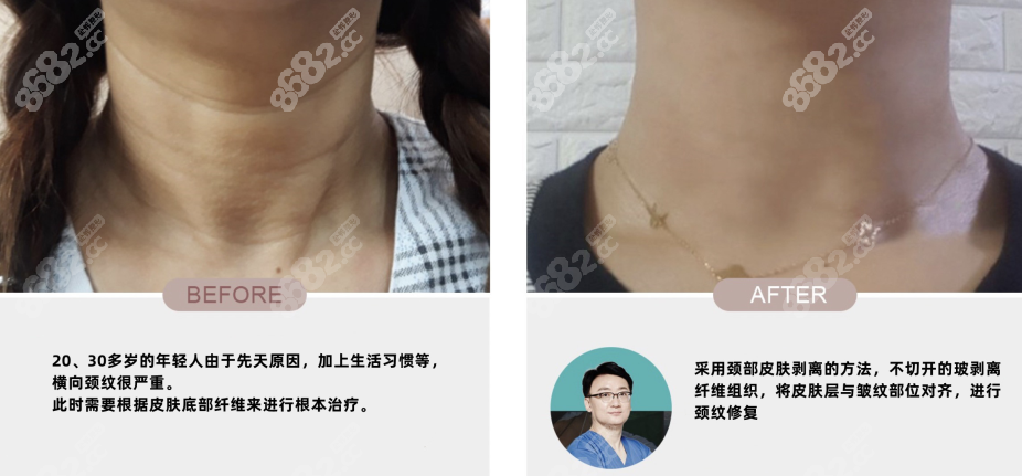 韩国延世多仁医院颈纹真人实例对比图
