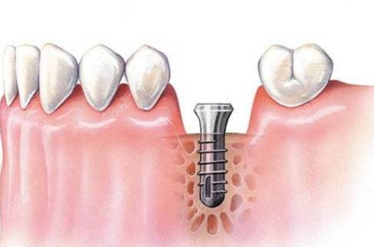 种植体示意图8682cc