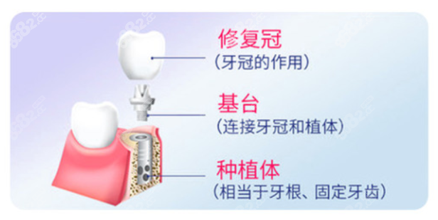 抚顺优嘉口腔种植牙多少钱一颗