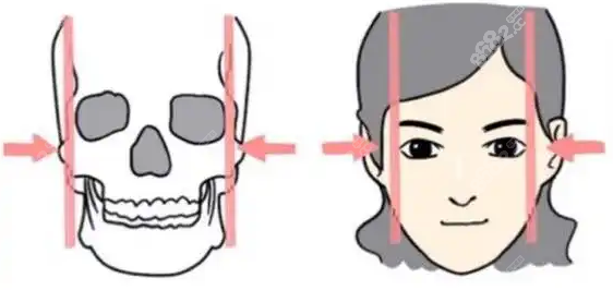 颧骨内推实例8682网