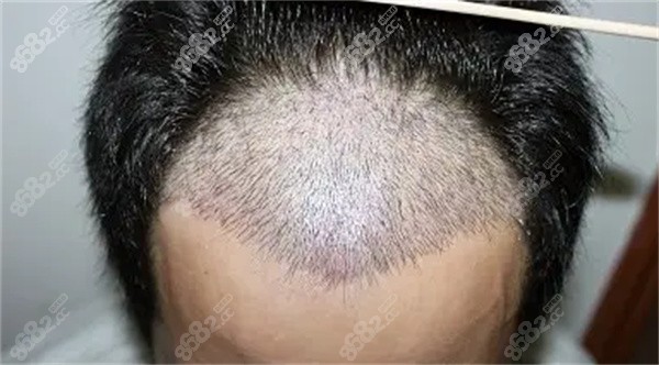 不剃发植发是什么原理？