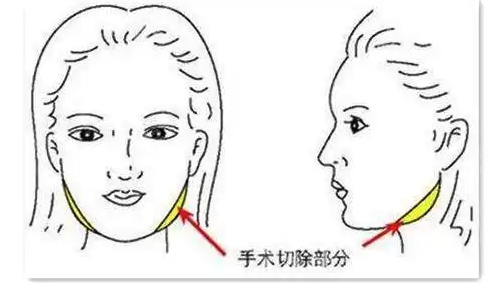 国内削骨厉害有名的医生是谁