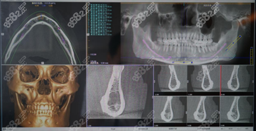 杭州连天美3D CT为主导的个性化手术方案