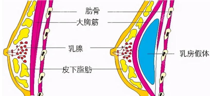 隆胸手术