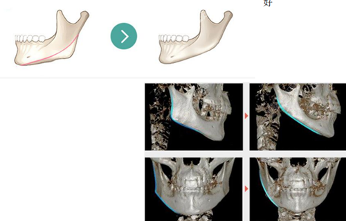 杭州连天美下颌角手术