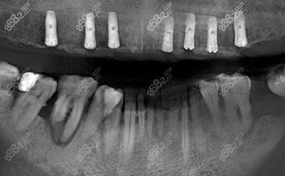 常规半口种植牙图