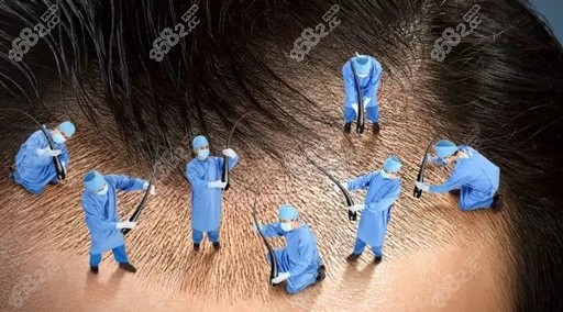 北京自体毛发移植多少钱