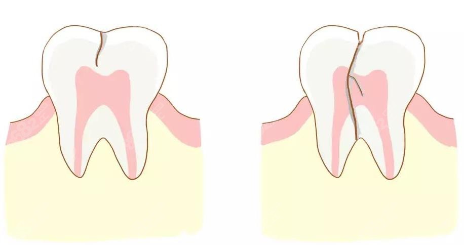 牙齿劈裂会引起根管治疗后隐隐作痛8682.cc