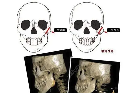 国内削骨医生推荐www.8682.cc