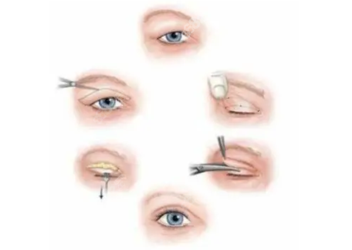 高汉雄医生修复高难度双眼皮手术