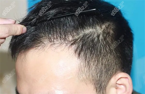 不剃发植发有尴尬期吗？