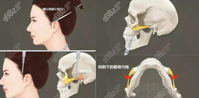 韩国颧骨内推比中国好吗www.8682.cc