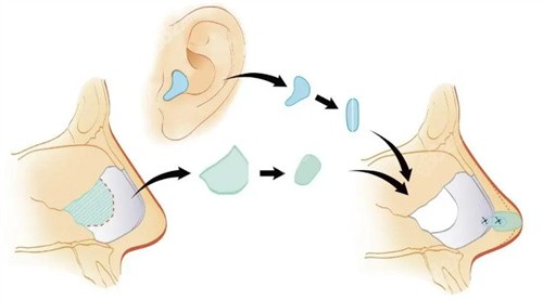 武汉自体耳软骨隆鼻