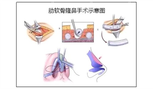 肋软骨隆鼻的步骤分解