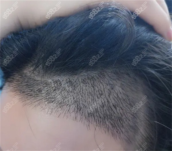 不剃发植发是什么原理？