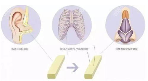 不同位置的软骨都需要被雕刻成合适的形状