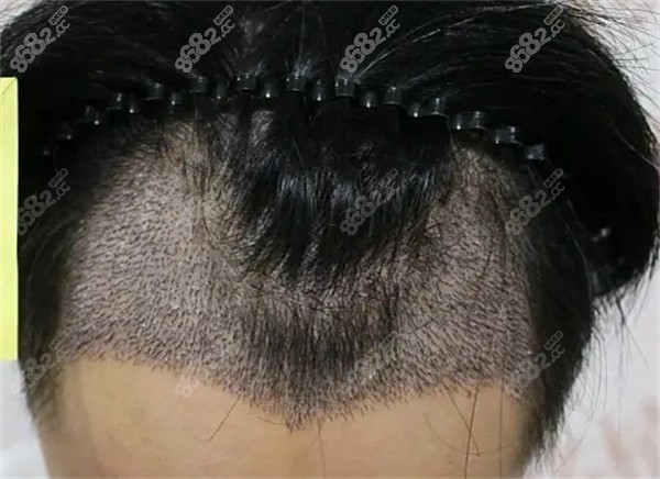 不剃发植发有尴尬期吗？