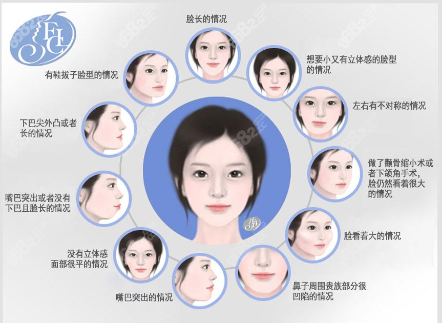 韩国菲斯莱茵双鄂手术改善脸型