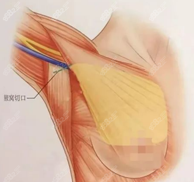 唐新辉医生隆胸