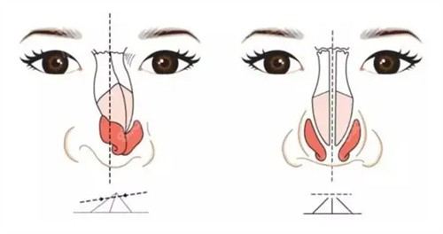 武汉歪鼻修复手术哪家好