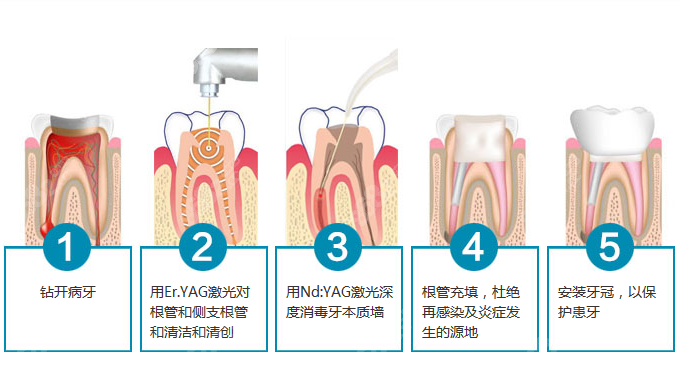 根管治疗后隐隐作痛可能是医生操作不当