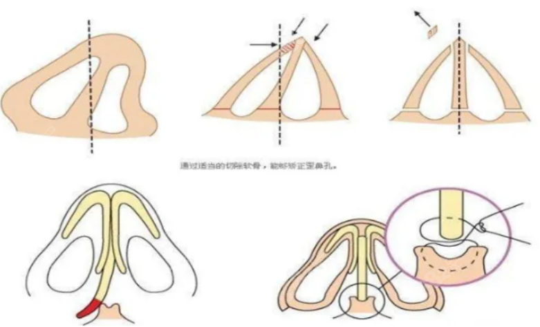 假体隆鼻手术