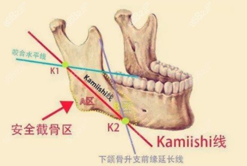 <!--<i data=20240705-sp></i>-->下颌角整形优势介绍