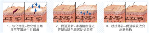 成都军建点阵激光法祛疤