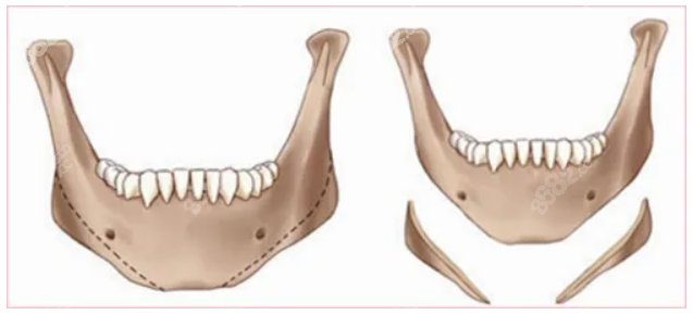 下颌角截骨手术示意图