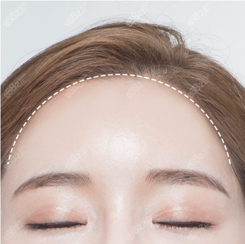 韩国布莱克植发女士发际线