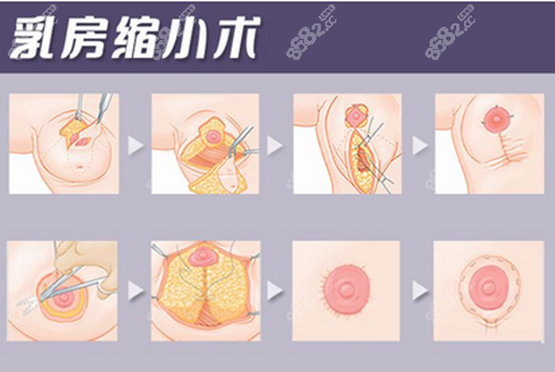 乳房缩小手术