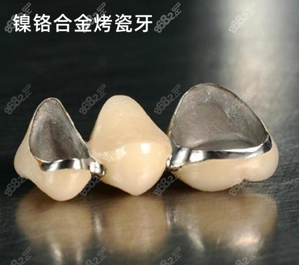 镍铬合金和钴铬合金