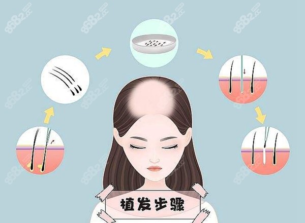 植发流程