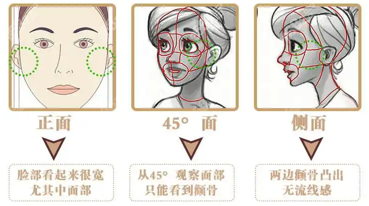 韩国十五分钟微创颧骨内推手术原理