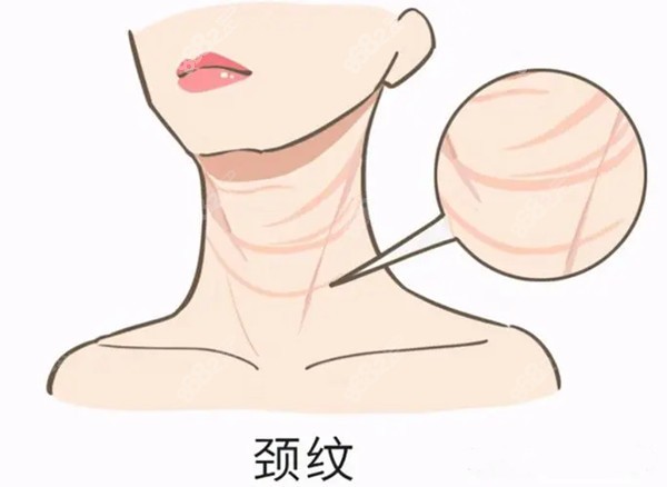 嗨体去颈纹一次多少钱