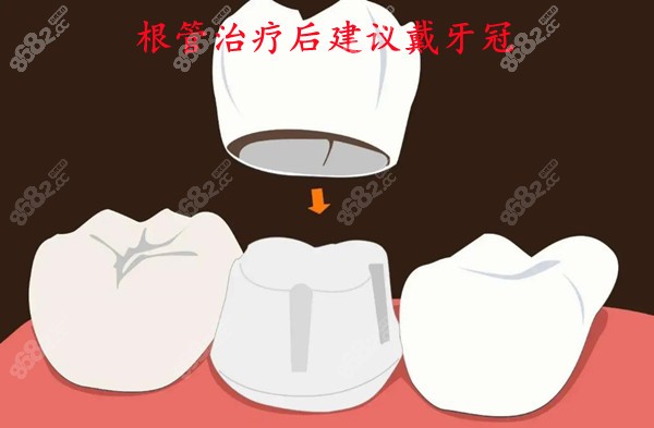 厦门口腔根管治疗戴牙冠的费用8682.cc